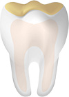 Tooth With Acid Erosion Tooth With Acid Erosion