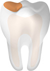 Tooth With Cavity Main Tooth With Cavity Main