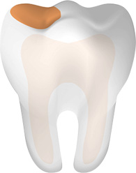 Tooth With Cavity Main Mobile Tooth With Cavity Main Mobile